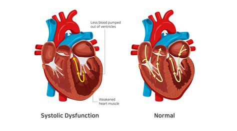 lv systolic dysfunction